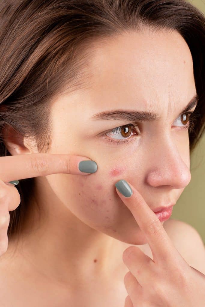 acne skin treatments