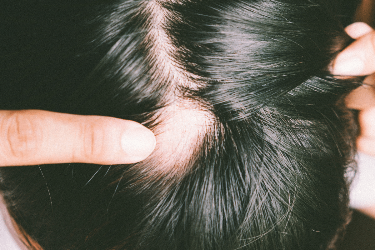 bald spots in hair alopecia