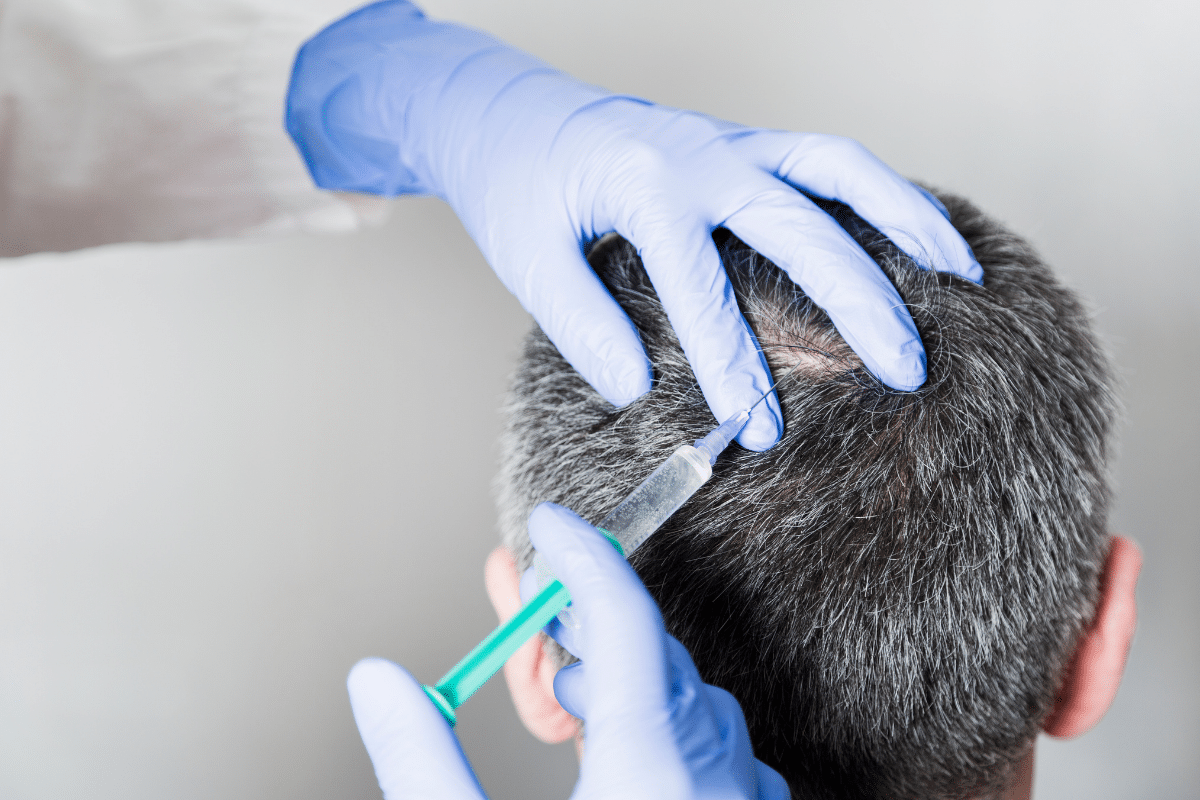 alopecia hair injections
