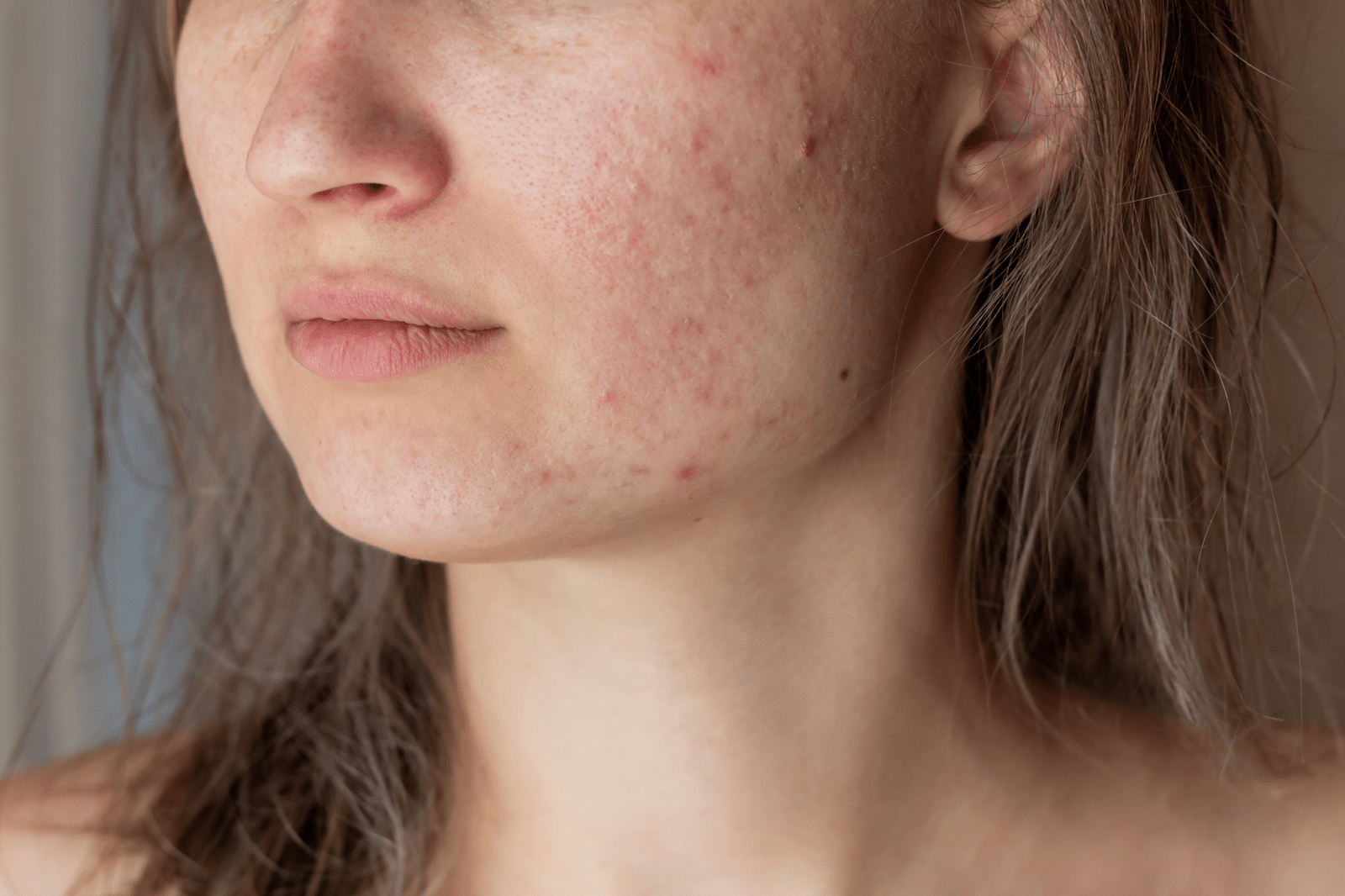 acne skin