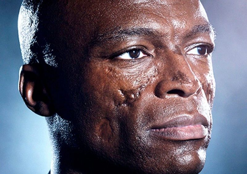 Seal's Facial Scars From Lupus