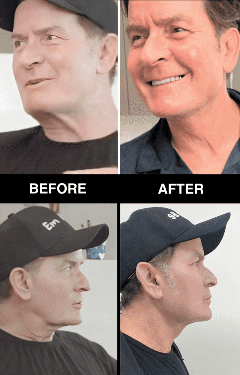 Charlie Sheen: A No-Scar Approach to Looking Refreshed