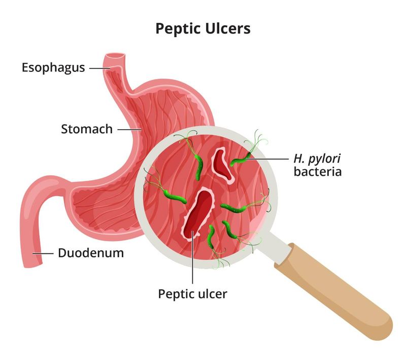Ulcers Are Caused by Stress