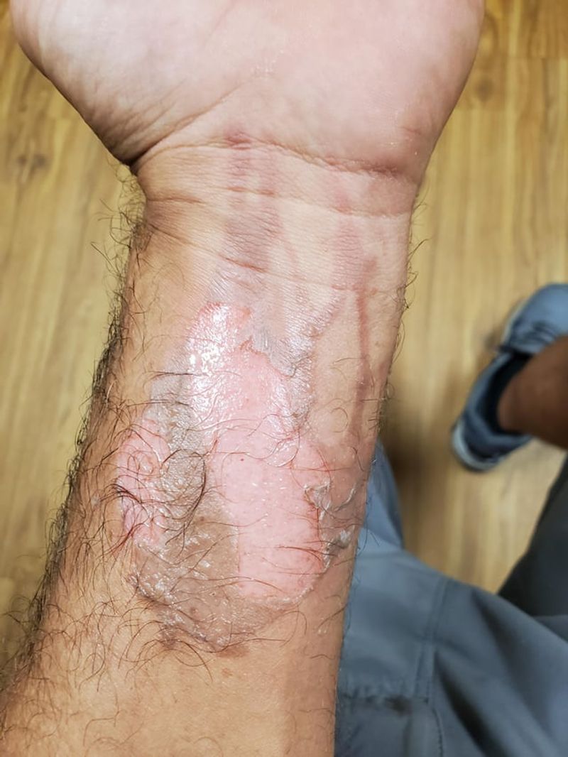 Burning Yourself Is Almost a Badge of Honor